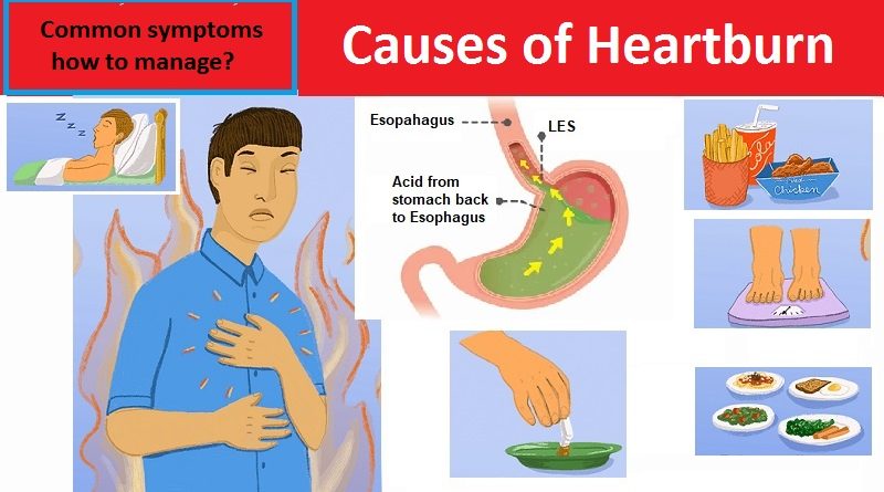 Causes of Heartburn, common symptoms, how to manage?