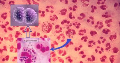How to diagnose Gonorrhea, and treatment options