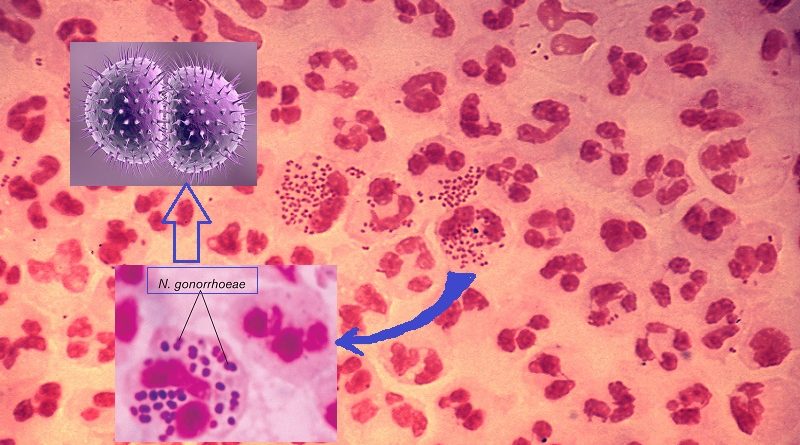 How to diagnose Gonorrhea, and treatment options