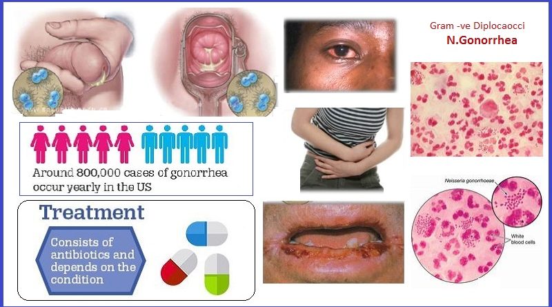 gonorrhea facts