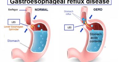 Gastroesophageal reflux disease