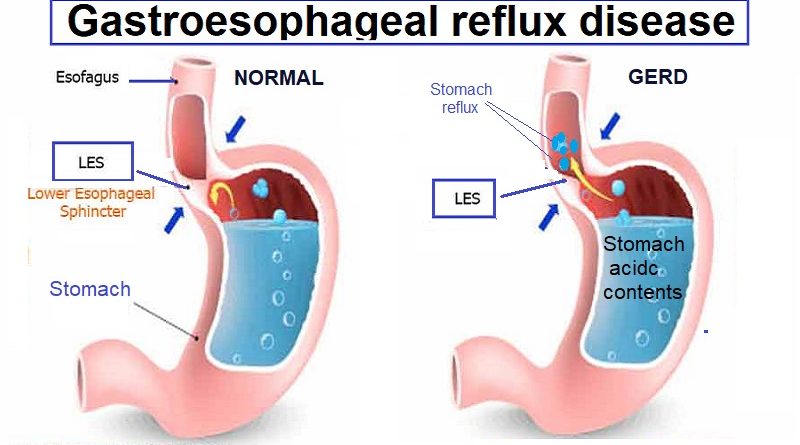 Gastroesophageal reflux disease