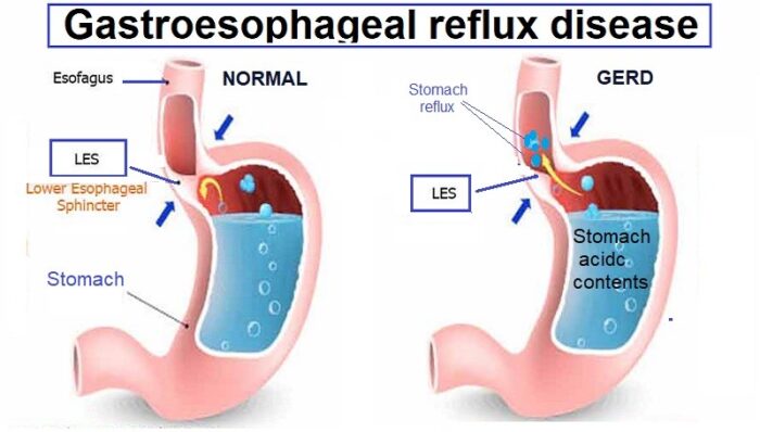 Gastroesophageal reflux disease