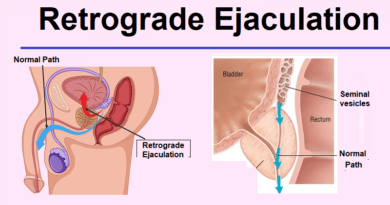 Retrograde ejaculation treatment, What are its causes?