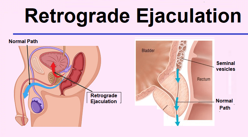 Retrograde ejaculation treatment, What are its causes?