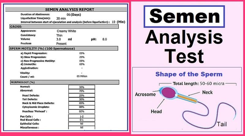 semen analysis - Sperm count