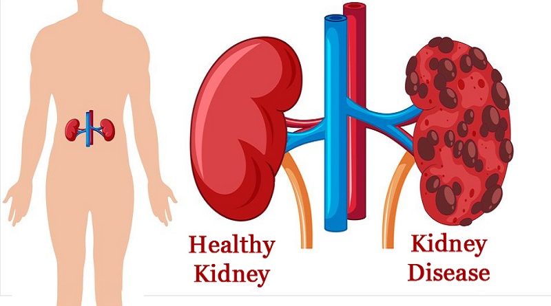 Kidney Diseases , Types and Diagnosis