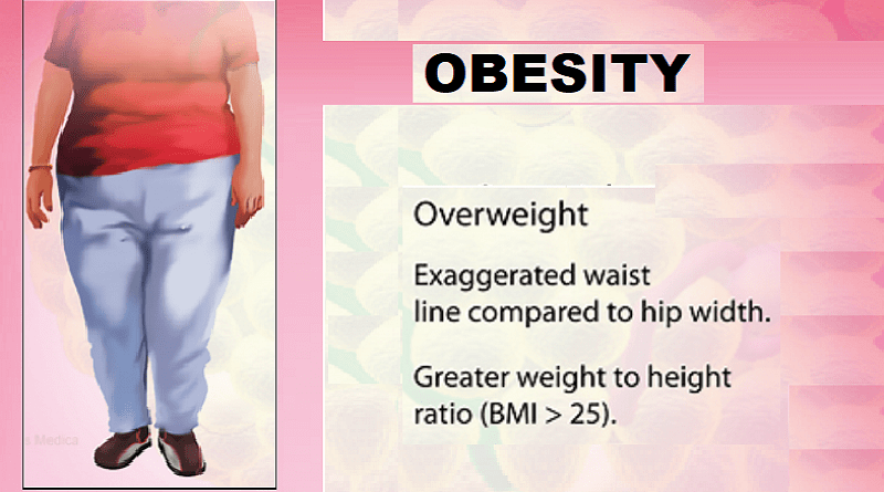 OBESITY