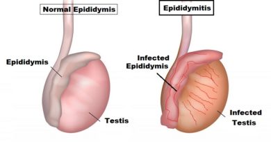 Epididymitis: Causes, Symptoms, and Treatment