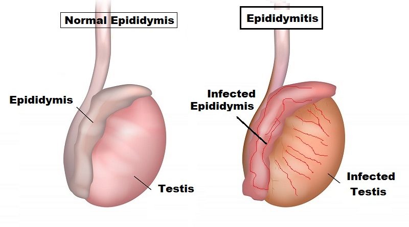 Epididymitis: Causes, Symptoms, and Treatment