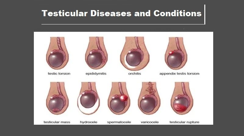 Introduction to Testicles and Testicular Diseases