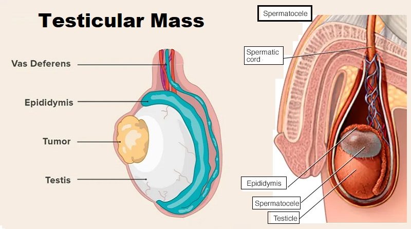 Testicular Mass: What You Need to Know