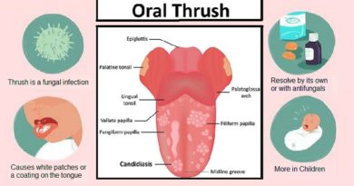 Thrush (Yeast infection): Causes and Treatment