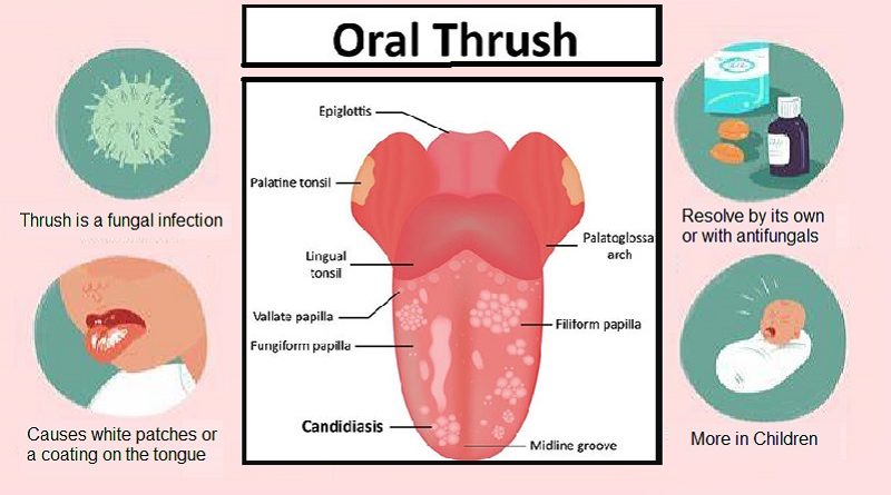 Thrush (Yeast infection): Causes and Treatment