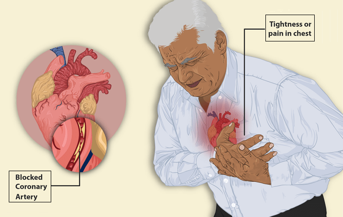 Understanding angina