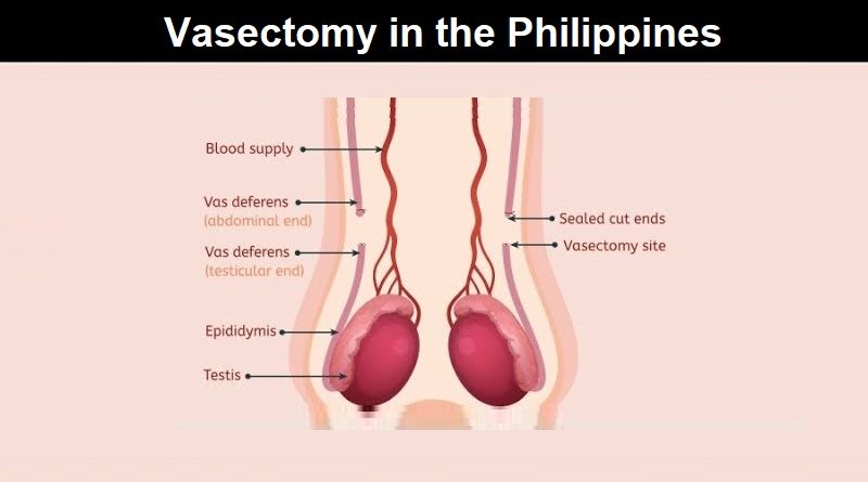 Vasectomy in the Philippines
