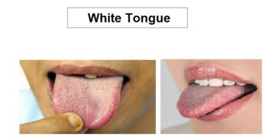 White tongue