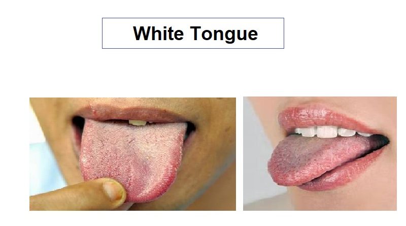 White tongue