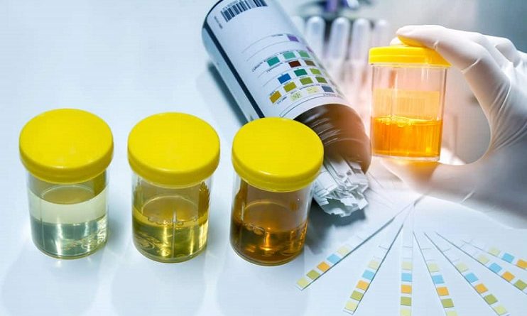 Urine Color Change: Most Common 5 Causes
