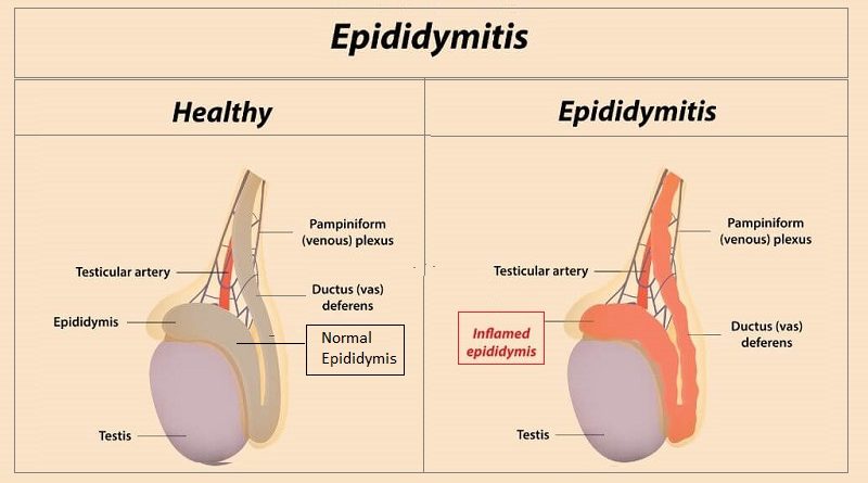Epididymis inflammation