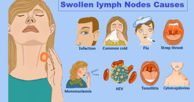 Swollen lymph Nodes: Causes, Symptoms, and Treatment Options