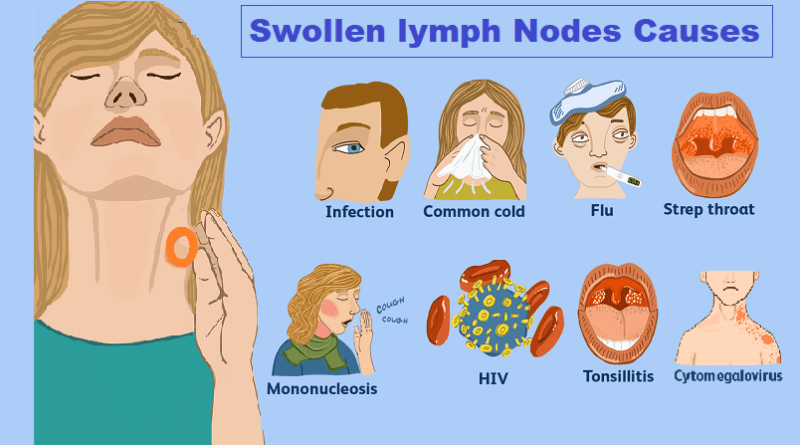 Swollen lymph Nodes: Causes, Symptoms, and Treatment Options