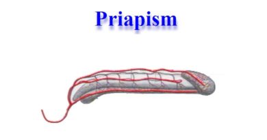 priapism