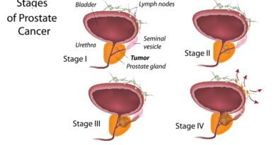 Prostate Cancer: Advances and Strategies for a Healthier Future