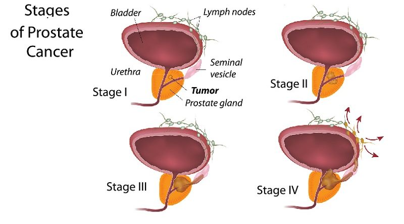 Prostate Cancer: Advances and Strategies for a Healthier Future