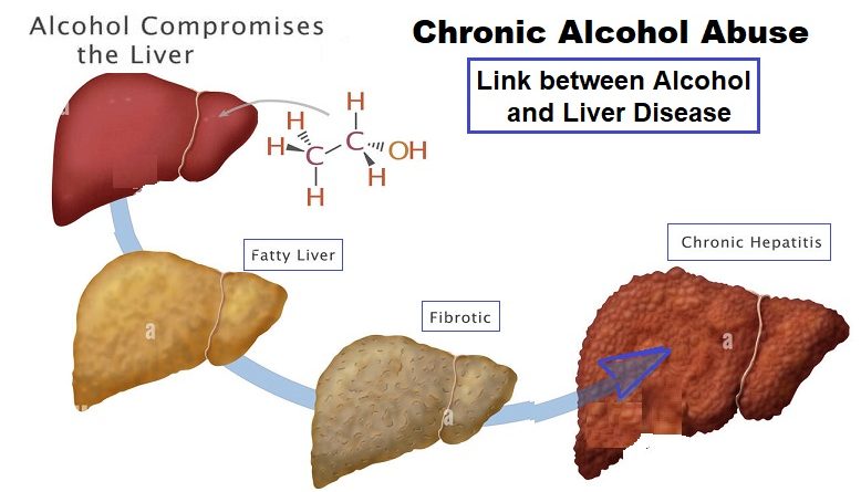 Chronic Alcohol Abuse: Understanding the Link between Alcohol and Liver Disease
