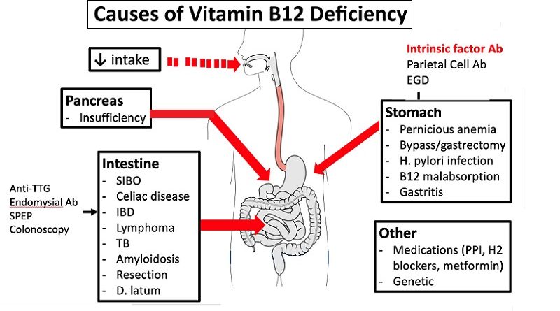 Causes of Vitamin B12 Deficiency