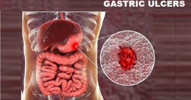 Gastric Ulcers: The Top 5 Symptoms and Signs