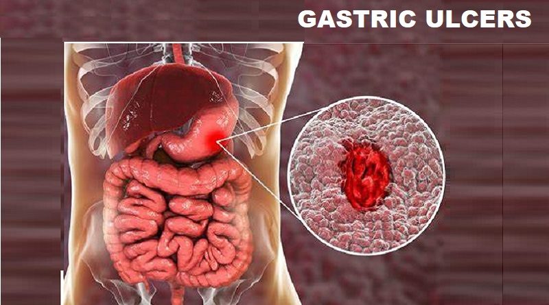 Gastric Ulcers: The Top 5 Symptoms and Signs