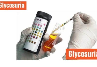 Glucose in Urine: The Difference Between Glycosuria and Glucosuria