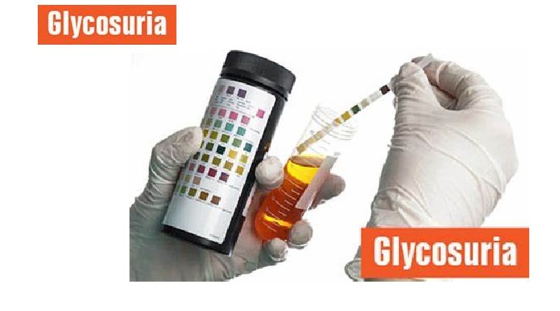 Glucose in Urine: The Difference Between Glycosuria and Glucosuria