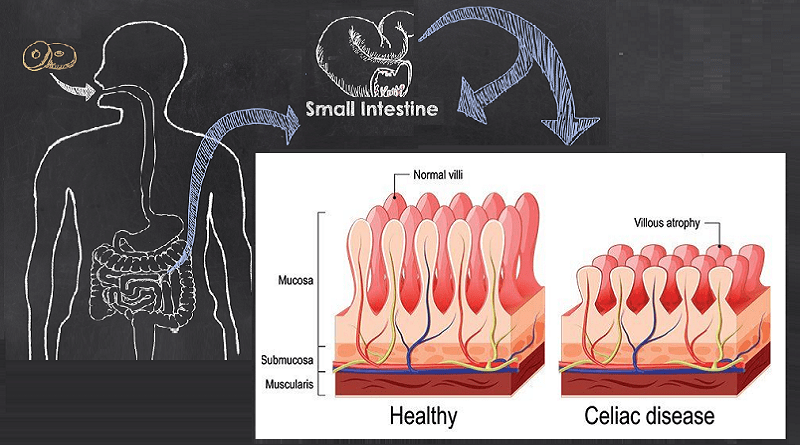 Exploring Celiac Disease and its Impact: Unveiling the Mystery
