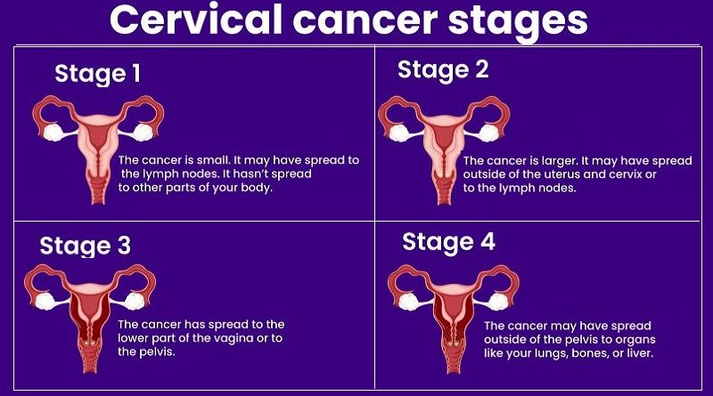 Cervical Cancer: Understanding the Causes, Symptoms, and Treatments