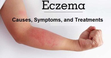 Eczema Causes, Symptoms, and Treatments
