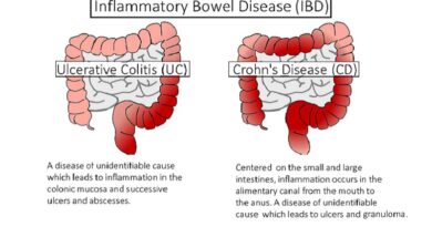 Inflammatory Bowel Disease (IBD)
