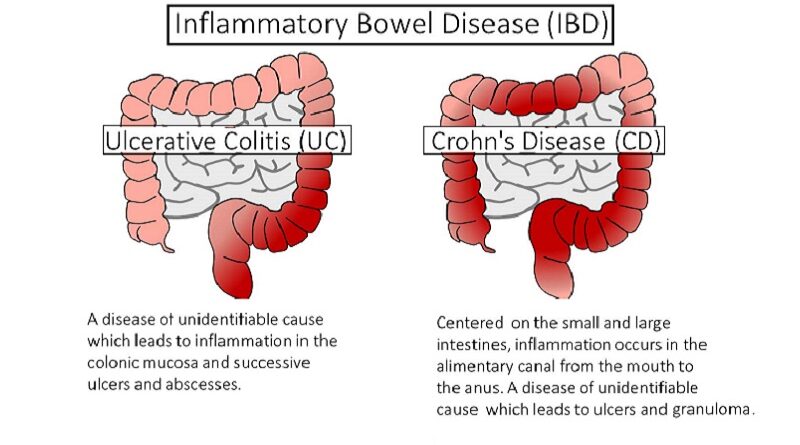 Inflammatory Bowel Disease (IBD)