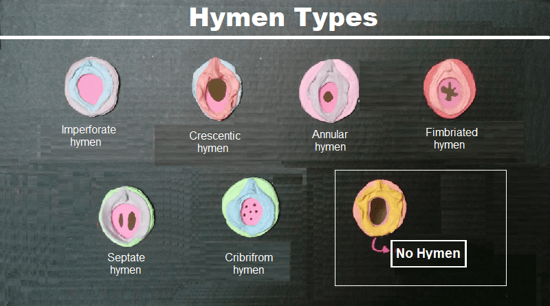 Hymen Types: Shapes and Sizes