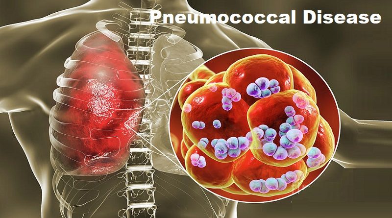 Pneumococcal Disease: Unveiling the Silent Threat