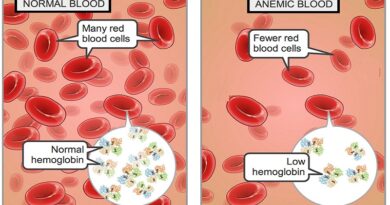 Iron Deficiency Anemia: the Common Cause of Fatigue