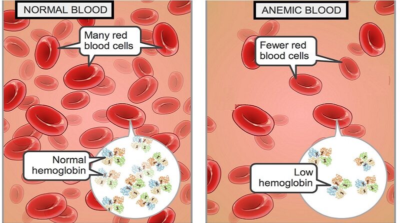 Iron Deficiency Anemia: the Common Cause of Fatigue