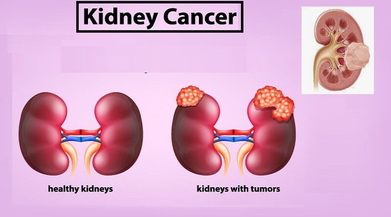 Kidney Cancer