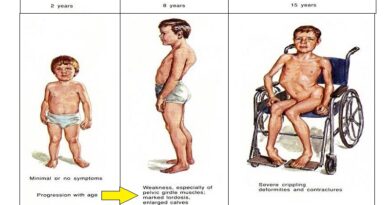 Muscular Dystrophy: A Complex Genetic Condition
