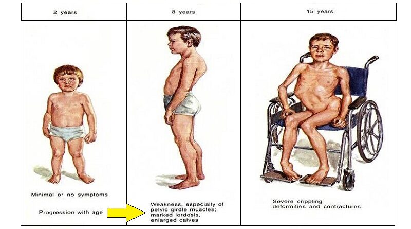 Muscular Dystrophy: A Complex Genetic Condition