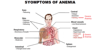 Anemia: Causes, Symptoms and Management