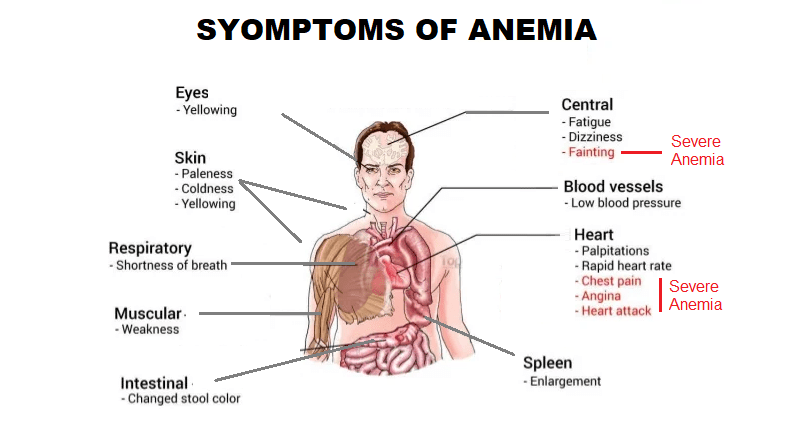 Anemia: Causes, Symptoms and Management