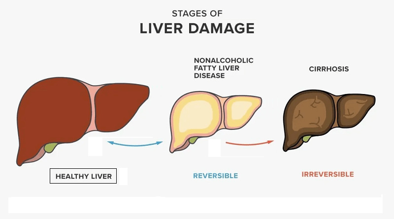 Liver Disease and its Impact on Health